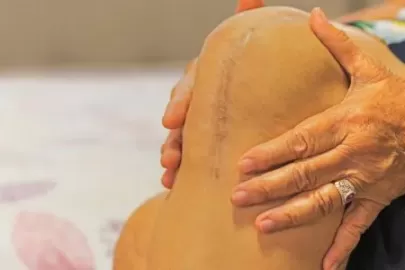 Back on Your Feet Faster: Modern Knee Surgery Recovery Facts