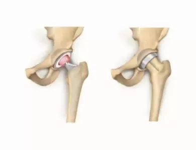 When is hip resurfacing a better option than hip replacement