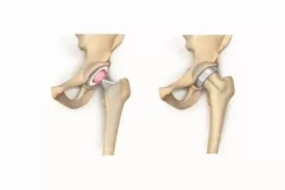 When is hip resurfacing a better option than hip replacement