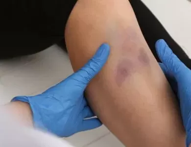 Is skin discoloration normal after fracture surgery