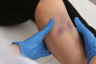 Is skin discoloration normal after fracture surgery