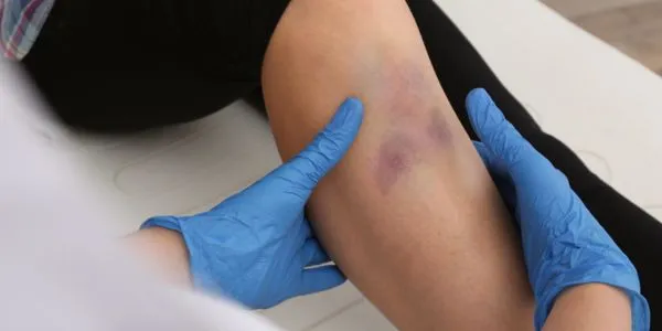 Is skin discoloration normal after fracture surgery