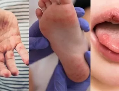 What is Hand-Foot-Mouth Disease (HFMD) and How Does It Affect Children?