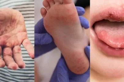 What is Hand-Foot-Mouth Disease (HFMD) and How Does It Affect Children?