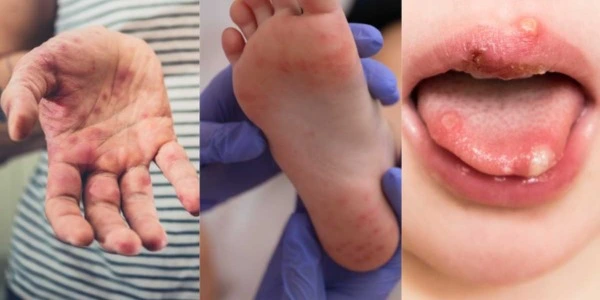 What is Hand-Foot-Mouth Disease (HFMD) and How Does It Affect Children?