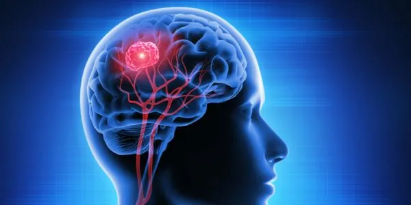 Early Detection: Why Timely Treatment of Brain Tumors is Crucial