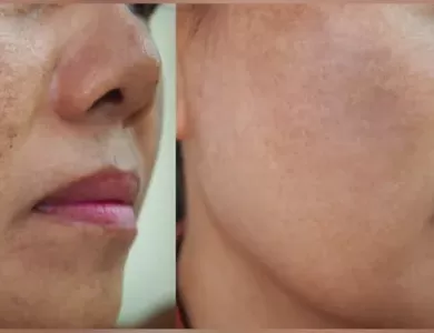 reasons for pigmentation on face