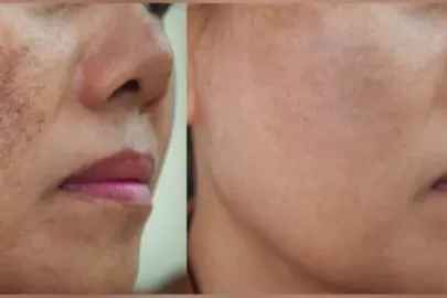 reasons for pigmentation on face