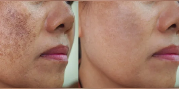 reasons for pigmentation on face