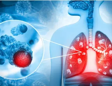 Lung Cancer Kaise Hota Hai