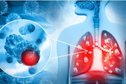 Lung Cancer Kaise Hota Hai