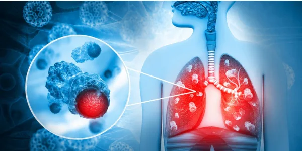 Lung Cancer Kaise Hota Hai