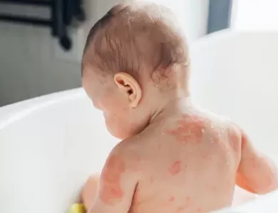 Baby Eczema