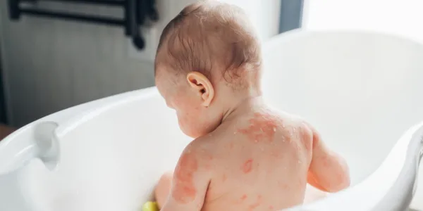 Baby Eczema